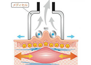 メディセルによる筋膜リリースのイメージ